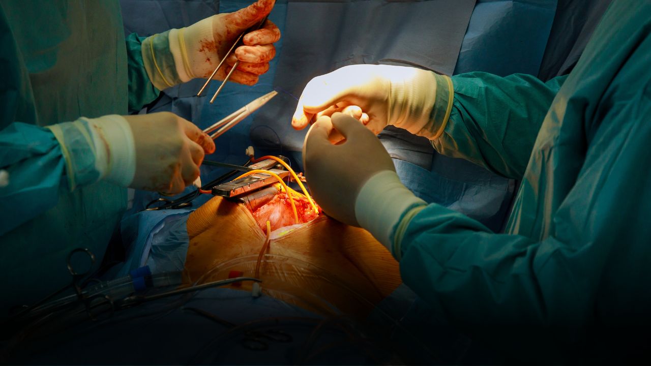 Heart Bypass Surgery
